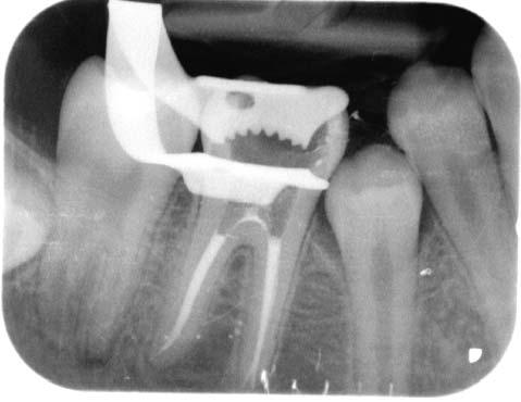 Case number 7 Figure 6-5: First postoperative radiograph