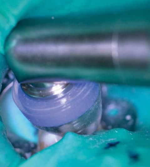 Figure 7-4: Once the posts were carefully removed the Caries Detector