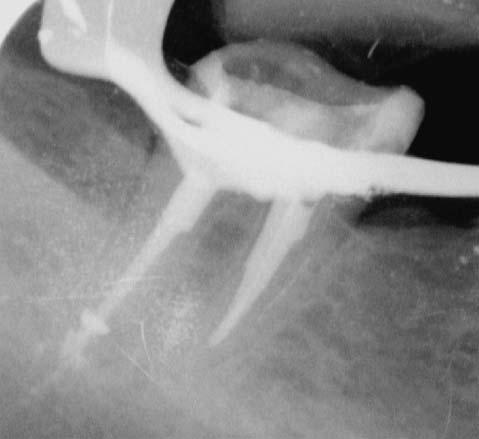 Conventional root canal sealers do not adhere to the dentinal walls or to Guttapercha.