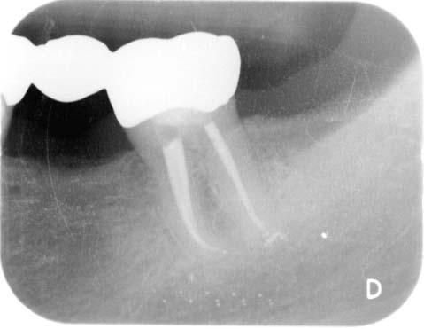 Ozonated NaOCl offers a tremendous time benefit making root canal disinfection predictable. References 1.