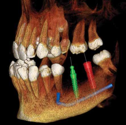 Superior Clinical Results Implant PreXion3D can provide you with the highest quality