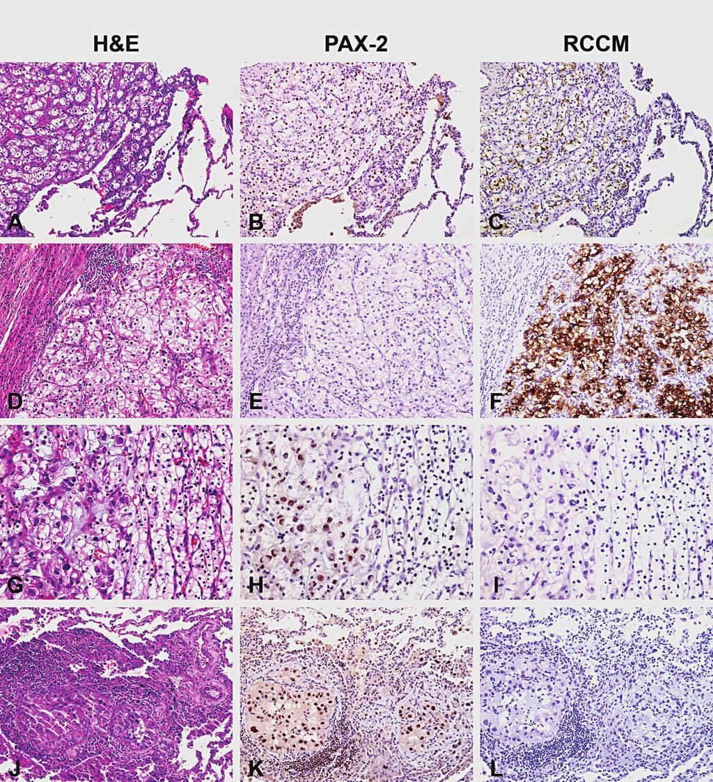 Figure 1. Metastatic clear cell/granular renal cell carcinoma.