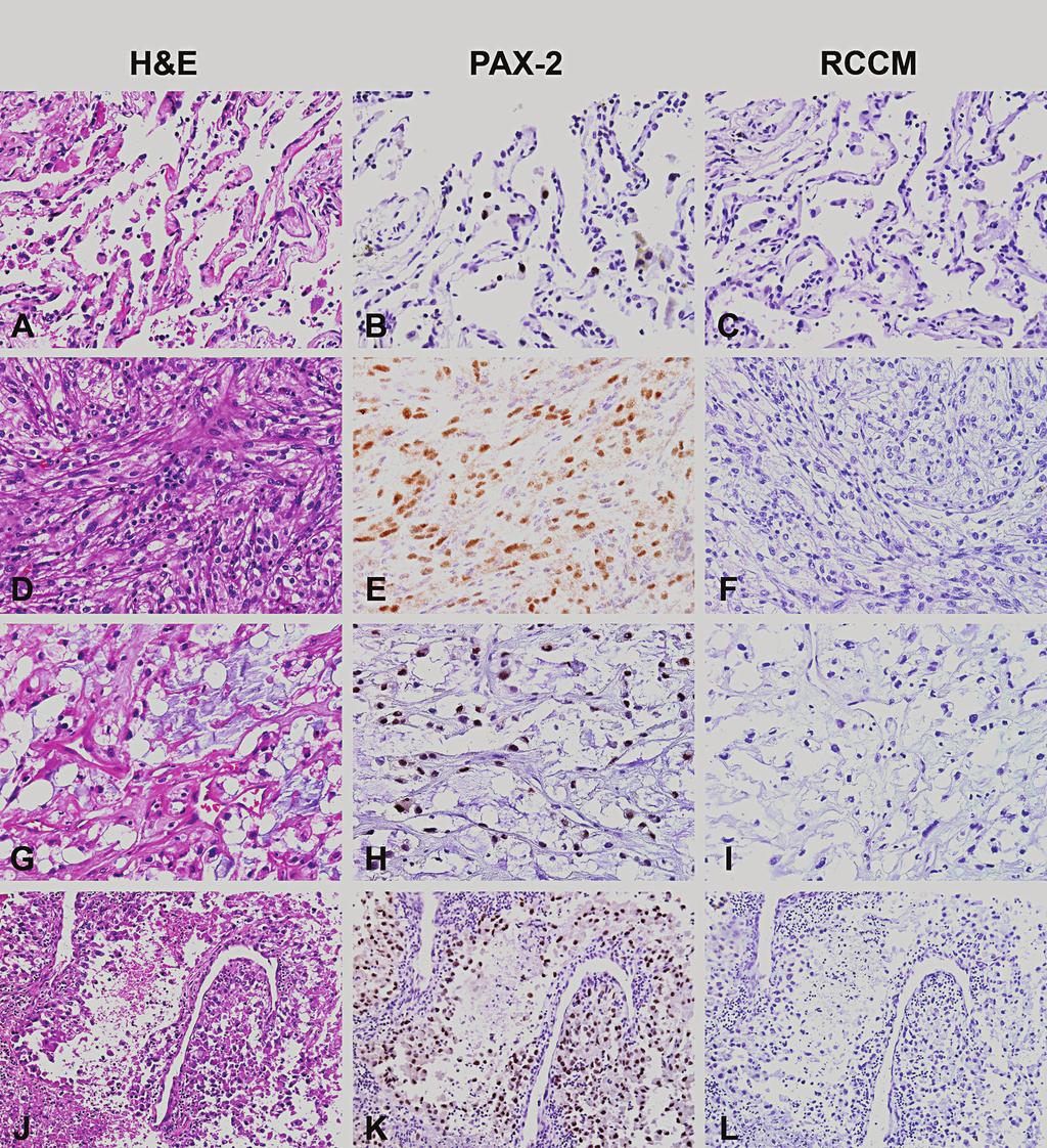 Figure 2. Metastatic clear cell/granular renal cell carcinoma.