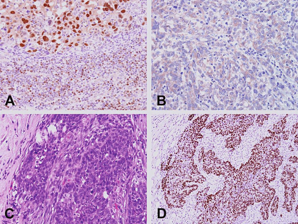 Figure 4. A, Breast ductal carcinoma metastatic to a lymph node showing strong PAX-2 staining. B, The primary tumor is negative for PAX-2. C, Undifferentiated ovarian carcinoma metastatic to omentum.