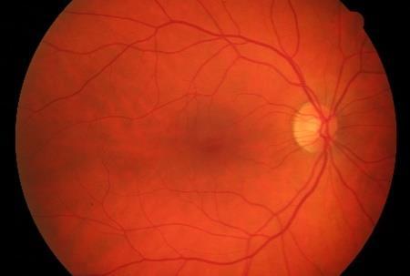 Extraction of retinal blood vessels and diagnosis of proliferative diabetic retinopathy using extreme learning machine, Journal of Medical
