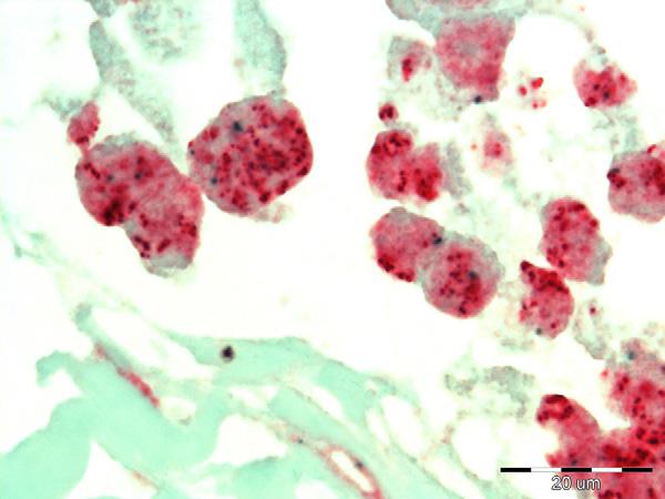 5% 0 Unsuitable for FISH assessment 0 0 0 0 Table 3 Correlation between FISH and CISH in the 41 breast cancer cases of the HER-2 equivocal group (as assessed by immunohistochemistry).
