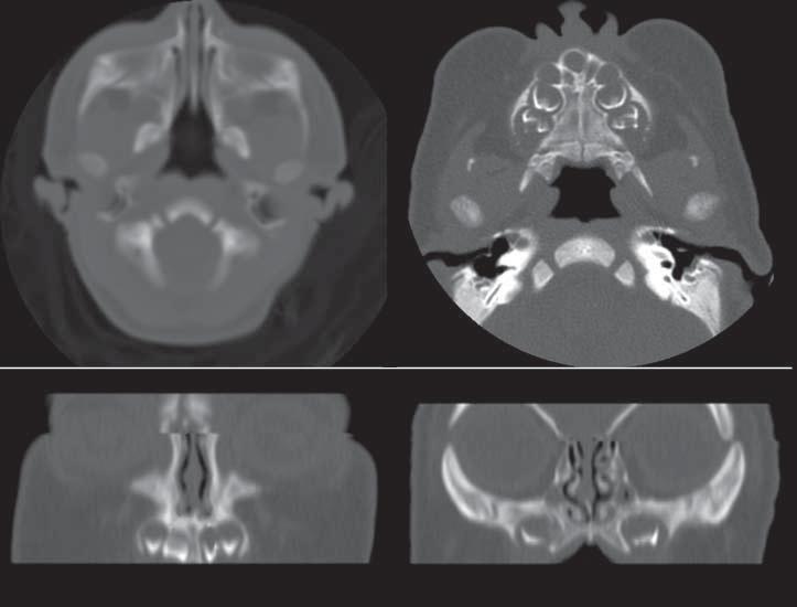 Research Original Investigation Figure 2. Radiographic Features of A B C D A, Axial maxillofacial computed tomographic (CT) scan at the level of the pyriform aperture.