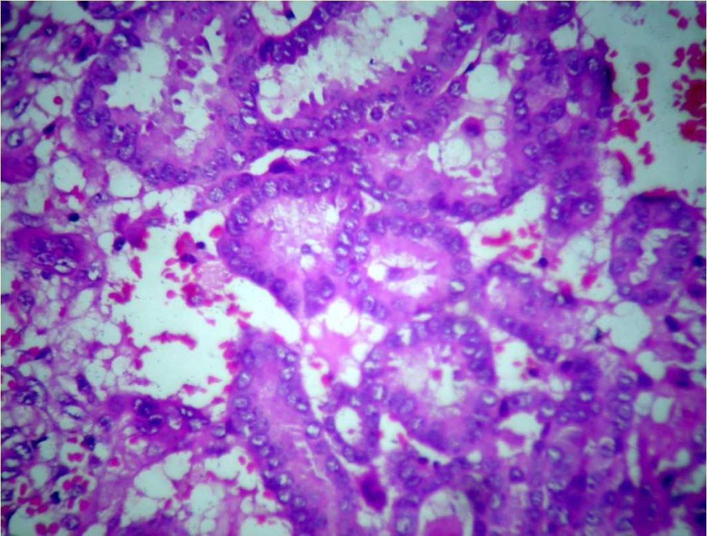 According to carcinoma histology, 68 cases had invasive ductal type, two