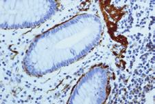 Prostate Cancer Androgen Receptor GM014 Catalog No.