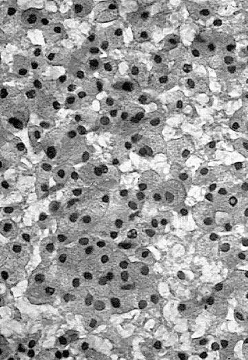 Acinic Cell Carcinoma Cells (high cellularity) Serous type acinar