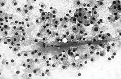 resistant cytoplasmic zymogen granules Bland nuclear cytologic