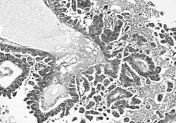 Quik stain Acinic Cell Carcinoma, papillary-papillocystic Pitfalls