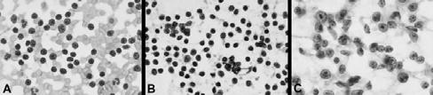 Salivary Gland Lymphomas MALT Follicular DLBCL Small lymphs, centrocytes, monocytoid B cells Slight nuclear atypia CD20+, 23-,