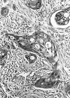 Mucoepidermoid Carcinoma High- Grade Cells High cellularity, obvious