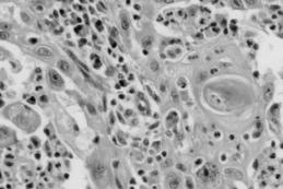 distinction between squamous and glandular cells Pleomorphism, prominent