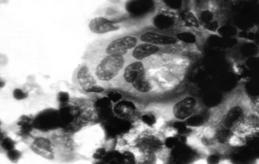 Malignant Mixed Tumor Rare, occurs in 5-9% of pleomorphic adenomas