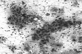Squamous Cell Carcinoma Rare salivary gland primary Metastases