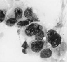 aggregates of malignant cells Pleomorphic nuclei with coarse