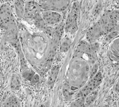 Keratinization favors a metastasis over MEC Salivary duct