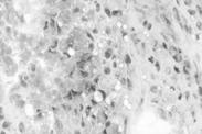 Myoepithelial carcinoma Clear Cell Tumors:
