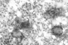 rapid growth presence or absence of pain Matrix: fibrillar arrays +/-embedded cells homogenous acellular