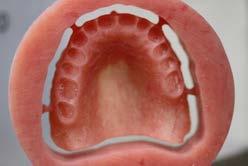 Denture Tooth
