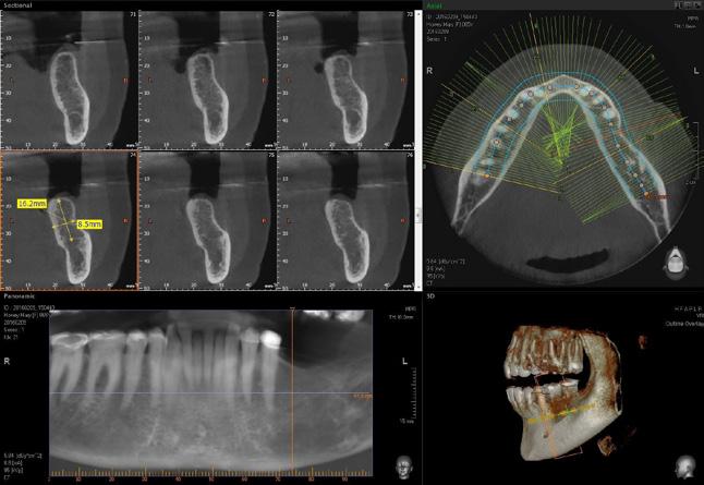 CASE #1 Figure 1: The pre-operative CBCT (Vatech America Green Imaging System, Fort Lee, NJ) illustrates the amount of available bone in the edentulous posterior mandible.