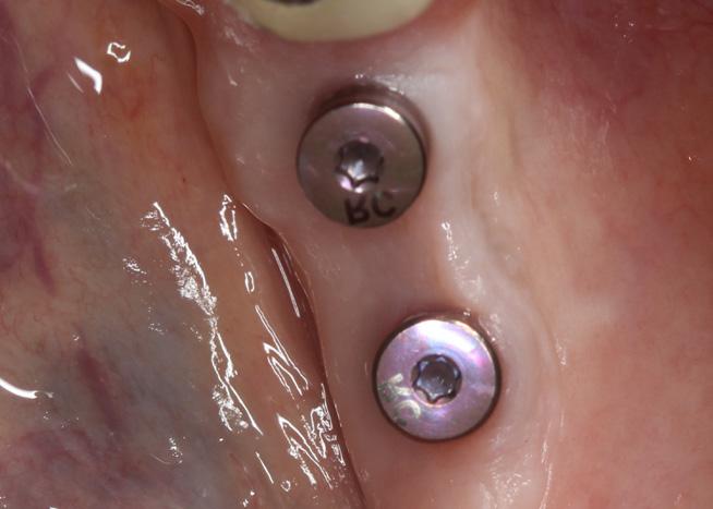 Figure 4: In this flapless surgical technique, the tissue heals well around the healing abutments.