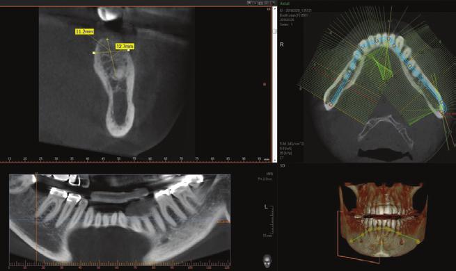 CASE #2 Figure 8: The CBCT analysis of the edentulous mandibular second molar site illustrates a significant lingual concavity, which must be understood, but adequate bone for safe placement of a