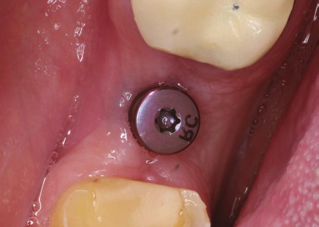 Figure 10: After uncovering, a taller healing abutment is placed to provide tissue control Figure 11: The healthy tissue cuff is observed providing a healthy periodontal condition.