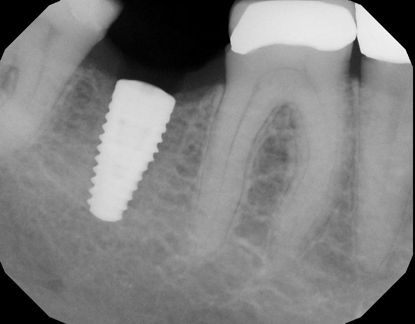 When creating a screw retained implant retained crown as shown in Case #2 (above), our lab fees are reduced about $100 per unit, but then there is chair time and composite material cost to cover the