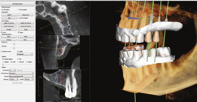Figure 13: The CBCT analysis illustrates adequate maxillary bone for implant placement.