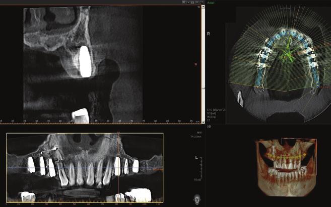This tool, along with the CBCT, provides the dentist the opportunity to evaluate vital anatomy, tooth contours, available bone and implant position.