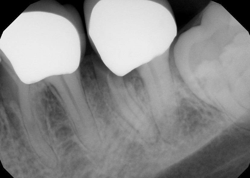 CASE #4 Figure 18: The mandibular second molar is