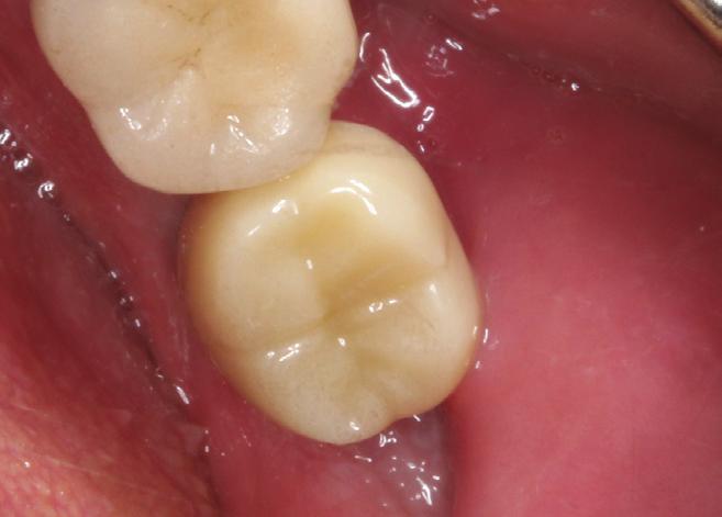 soft tissue cuff indicates a healthy periodontal
