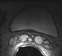 Clinical Challenges Need reliable staging Treatment Options Gland confined vs.