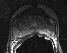 Axial View Dynamic Contrast Enhanced MRI (DCE-MRI) Contrast kinetics (Gd( Gd-DTPA) Surrogate of vascular