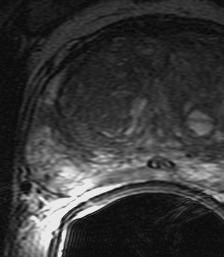 3T endo-rectal MRI of