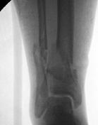(on steroids) 1/30/2017 29 Fresh Fracture