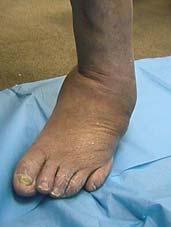 Difficult Fusions Ankle and Hindfoot Risk of 5-40% for ankle