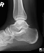 Difficult Fusions High Risk Ankle and Subtalar Fusion ORIF+BG 12/13 healed Donely and