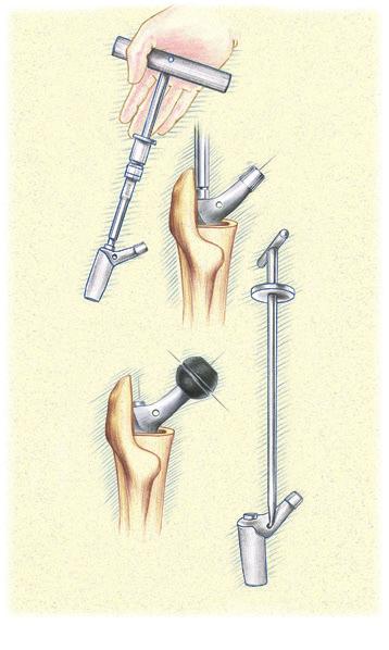 Cone Body Trial Fluted & Plasma Distal Stems Assemble the Appropriate Cone Body Trial to Cylindrical Distal Stem Select the Cone Body Trial corresponding both to the final Proximal Cone Reamer