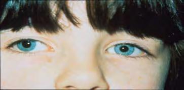 Subtypes of Amblyopia Anisometropic Unequal