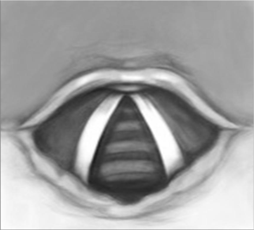 Airway Anatomy Vallecula Vocal cord Tongue
