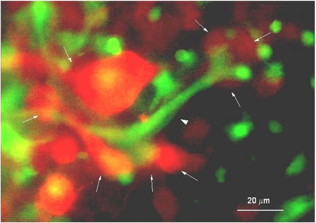 In vivo imaging with fluorescent proteins: the new cell biology 83 Figure 4. Interactions (arrows) of host stromal fibroblast cell (arrowhead) and cancer cells in live tumor tissue.