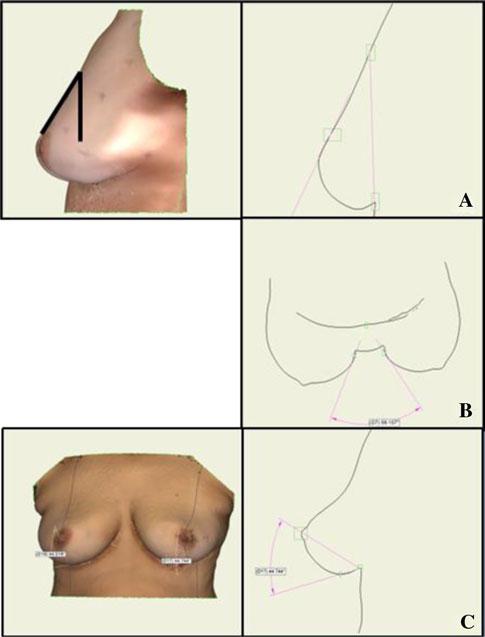 Aesth Plast Surg (2011) 35:357 364 359 To evaluate the potential redistribution of breast tissue, breast volume was calculated above and below the c plane through the lateral IMF.