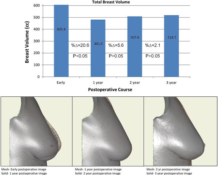 360 Aesth Plast Surg (2011) 35:357 364 Fig. 2 Three-dimensional breast volumes were calculated for all the patients at all pre- and postoperative time points.
