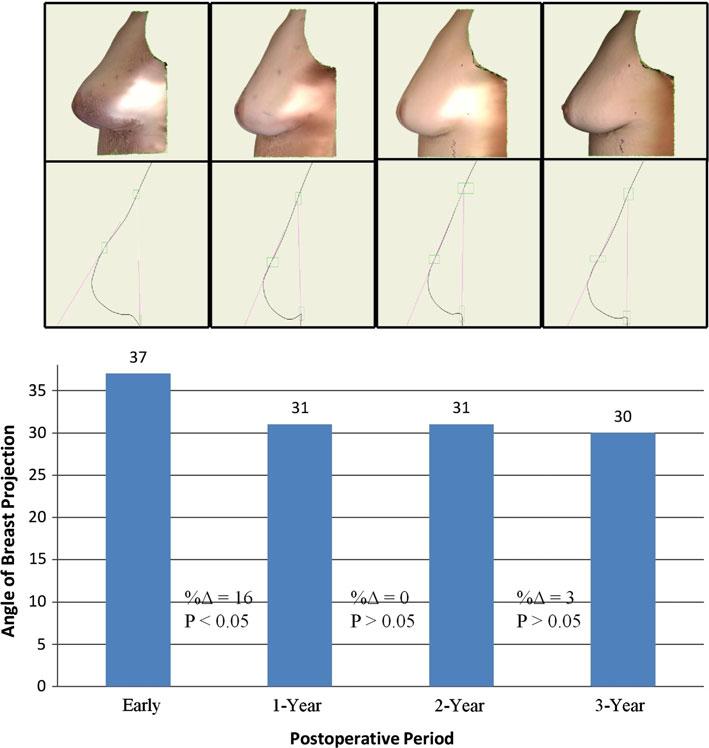 362 Aesth Plast Surg (2011) 35:357 364 Fig. 6 The angle of breast projection was measured for all time points.