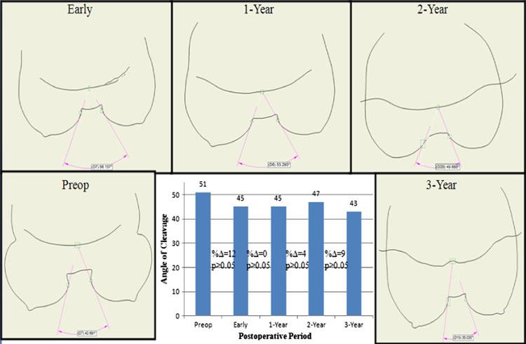 05) and then stabilizes in the latter years Fig. 7 The angle of cleavage was observed to be stable at all postoperative visits (P [ 0.