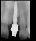 implant placement X-ray on 